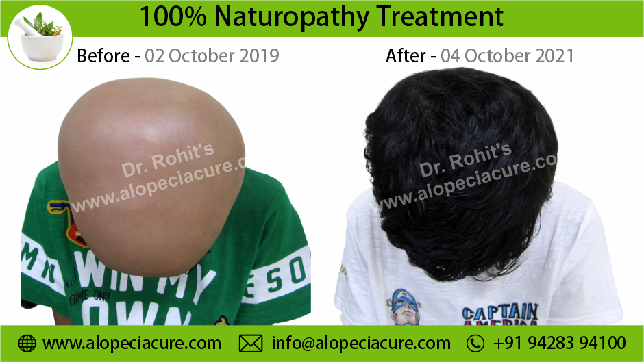 alopecia areata treatment South Africa